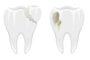 Cracked And Decayed Teeth