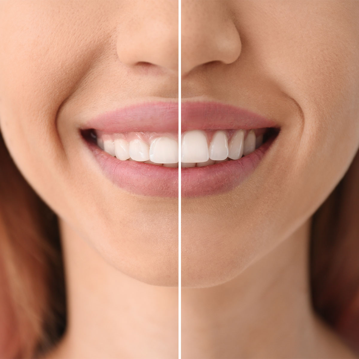 Gum Contouring Gum Contouring