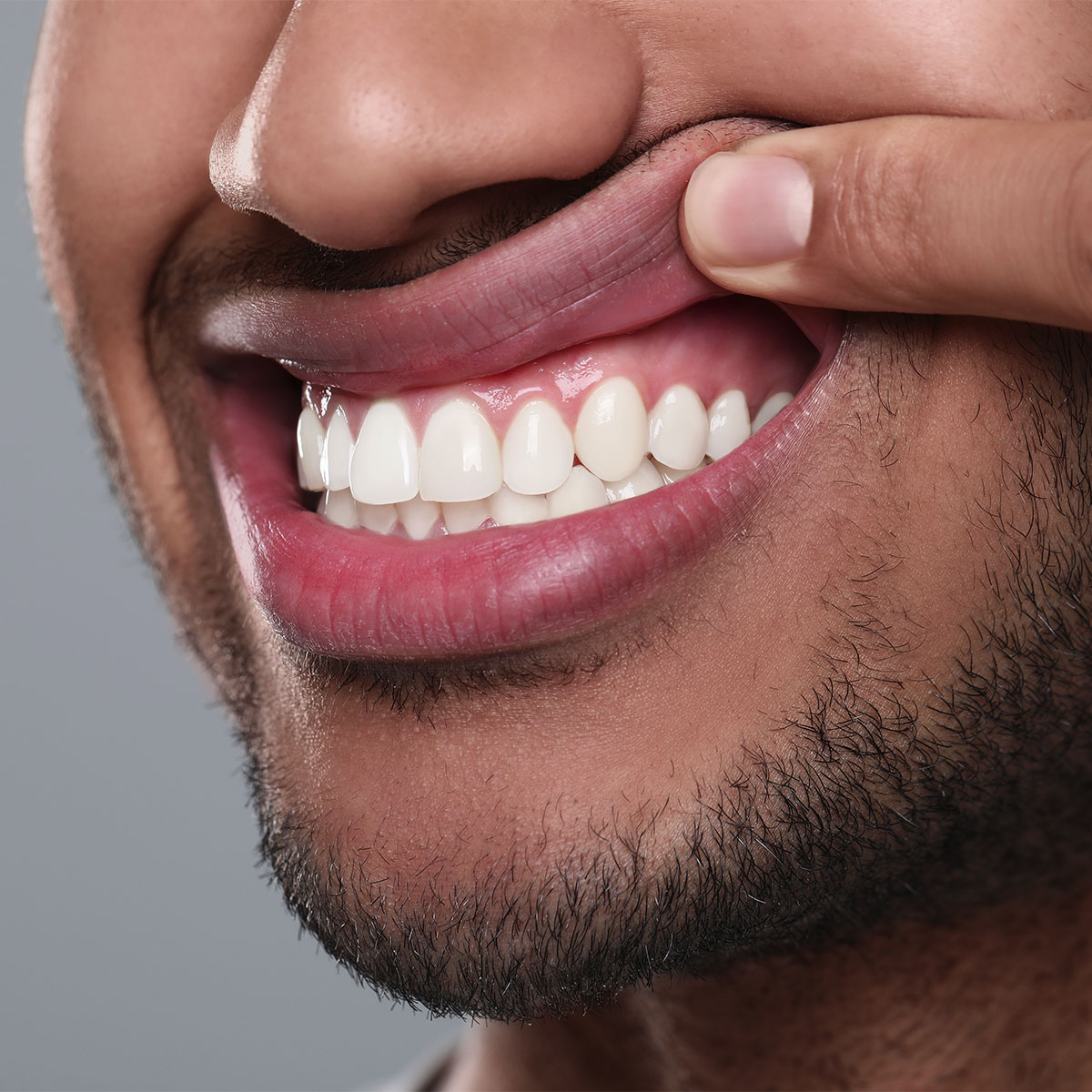 Gum Depigmentation Gum Depigmentation