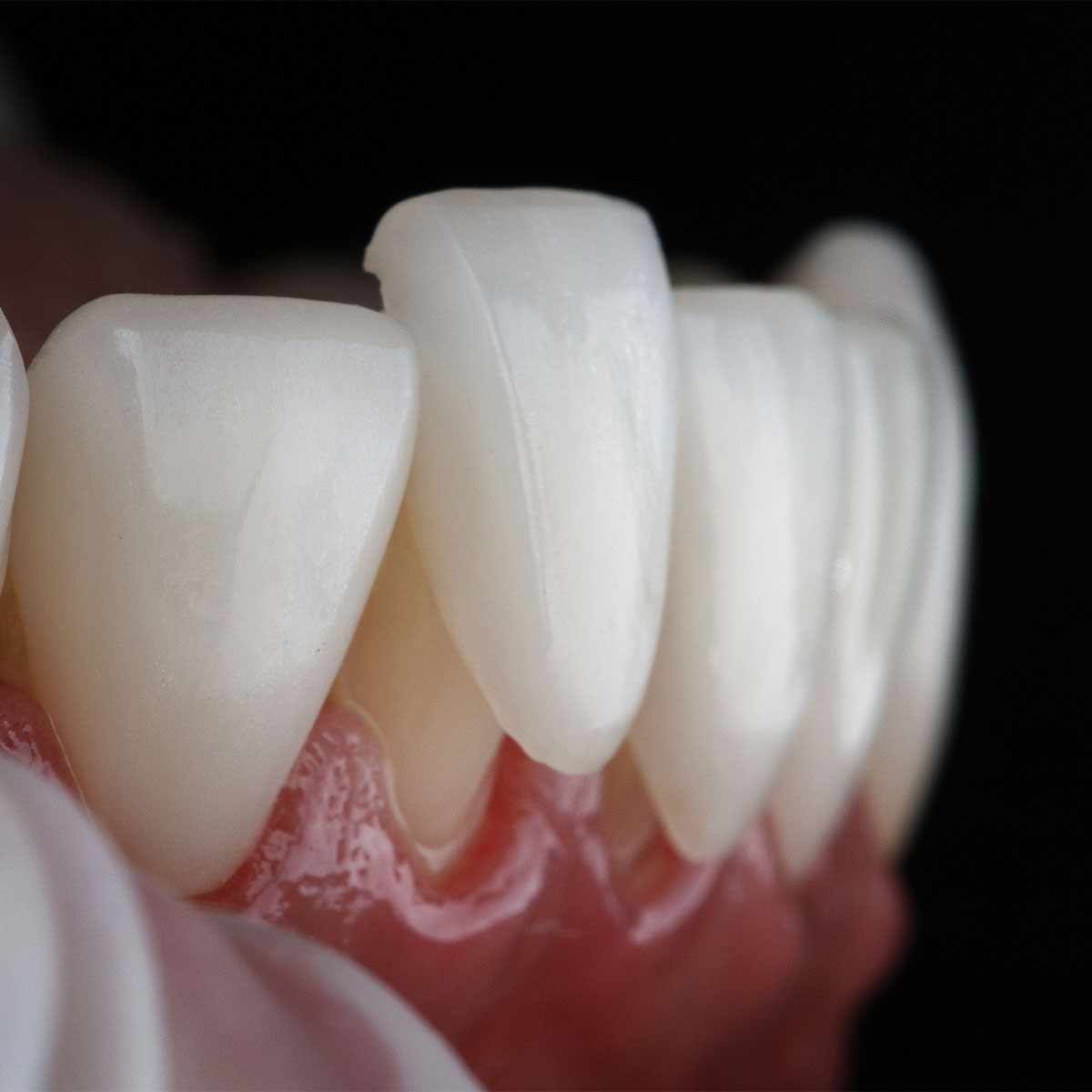 Porcelain Veneers Porcelain Veneers