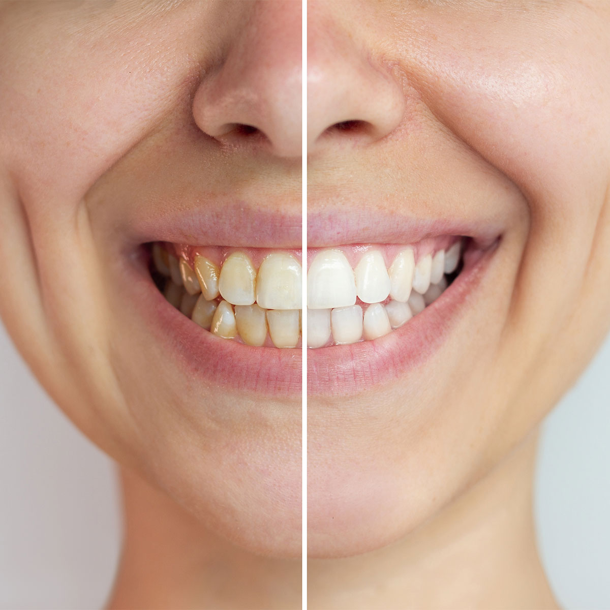 Teeth Whitening Teeth Whitening